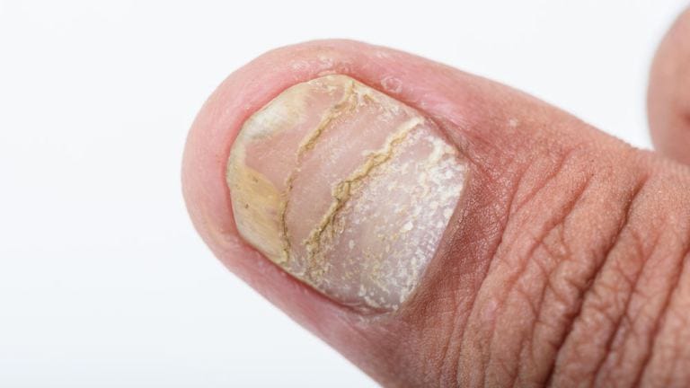 Psoriasi sulle unghie