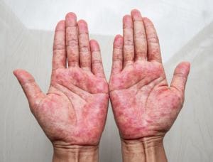 Dermatite atopica mani