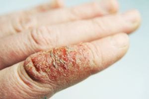Dermatite atopica mani tipo irritativo