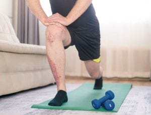 Psoriasi e sport