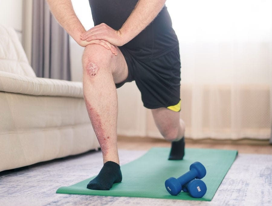 Psoriasi e sport