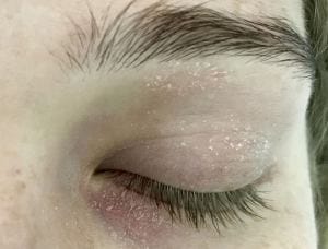Dermatite atopica contorno occhi