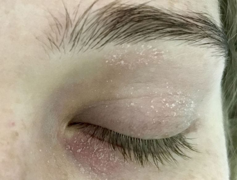 Dermatite atopica contorno occhi