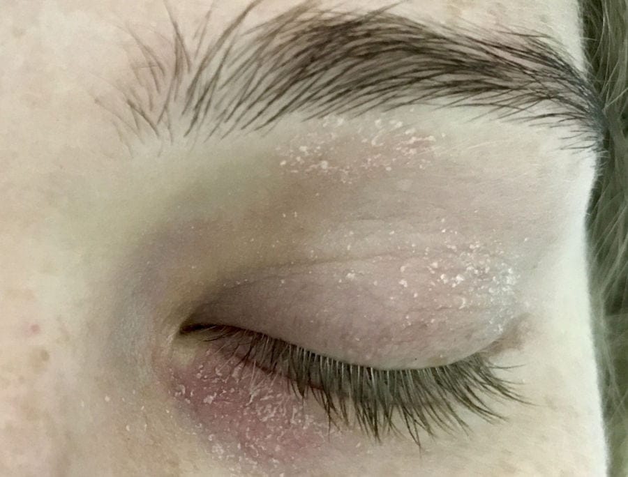 Dermatite atopica contorno occhi