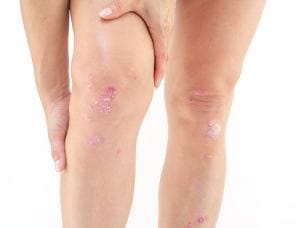Psoriasi invalidità