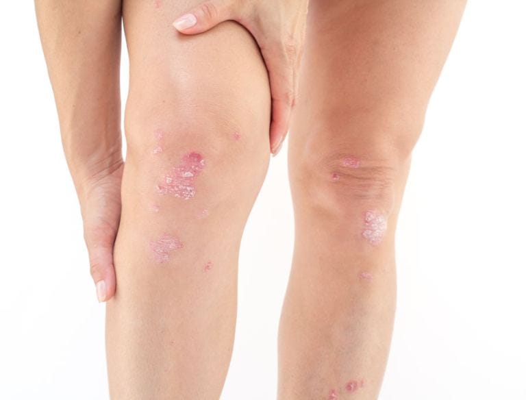 Psoriasi invalidità