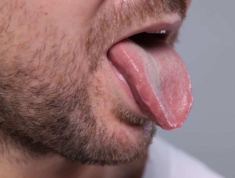 Psoriasi lingua