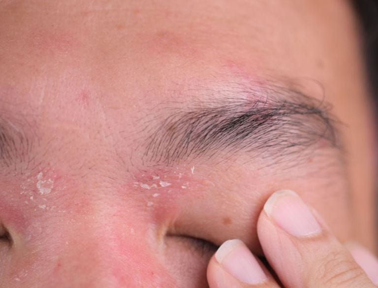 Psoriasi occhi