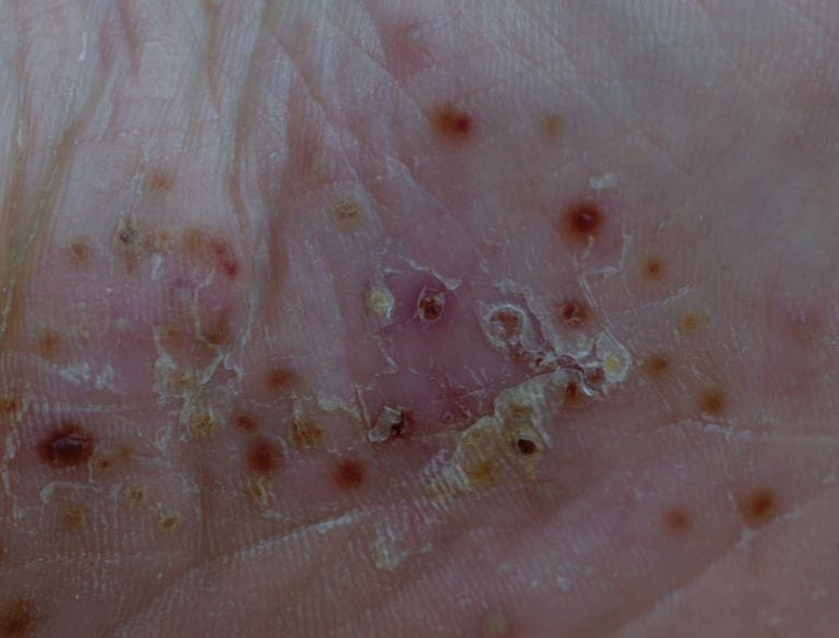 Psoriasi pustolosa generalizzata