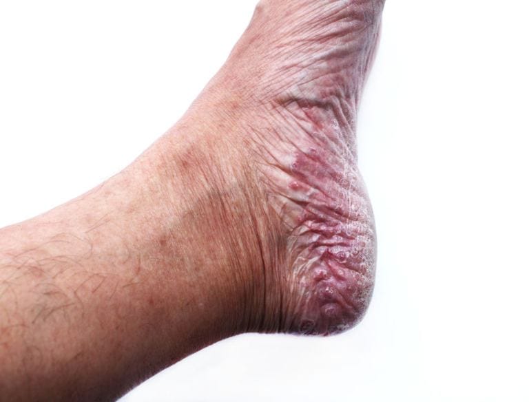 Psoriasi tallone