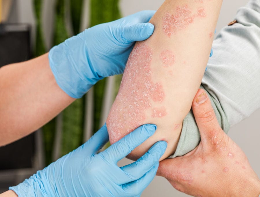 Terapia biologica psoriasi