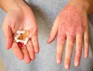 Vitamine dermatite atopica