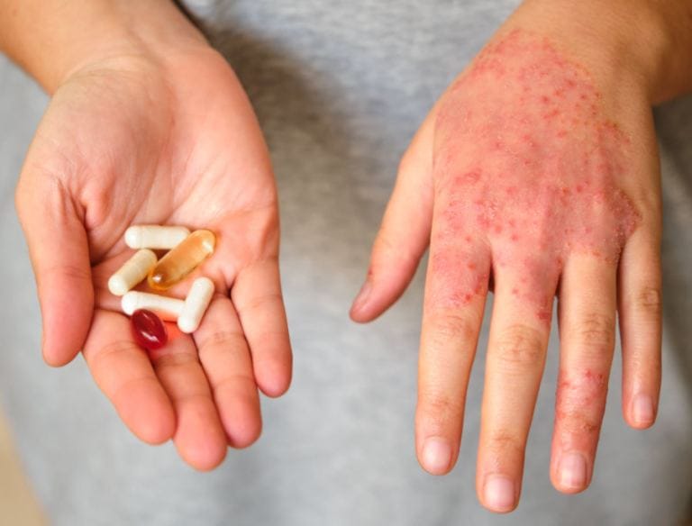 Vitamine dermatite atopica