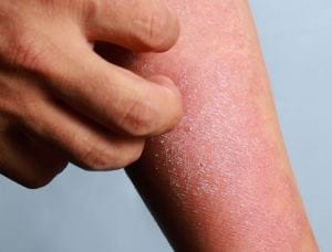 Alleviare prurito dermatite atopica