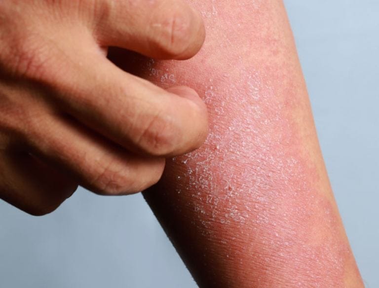 Alleviare prurito dermatite atopica