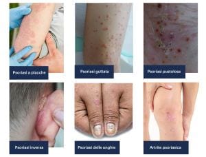 Alterazioni morfologiche della psoriasi