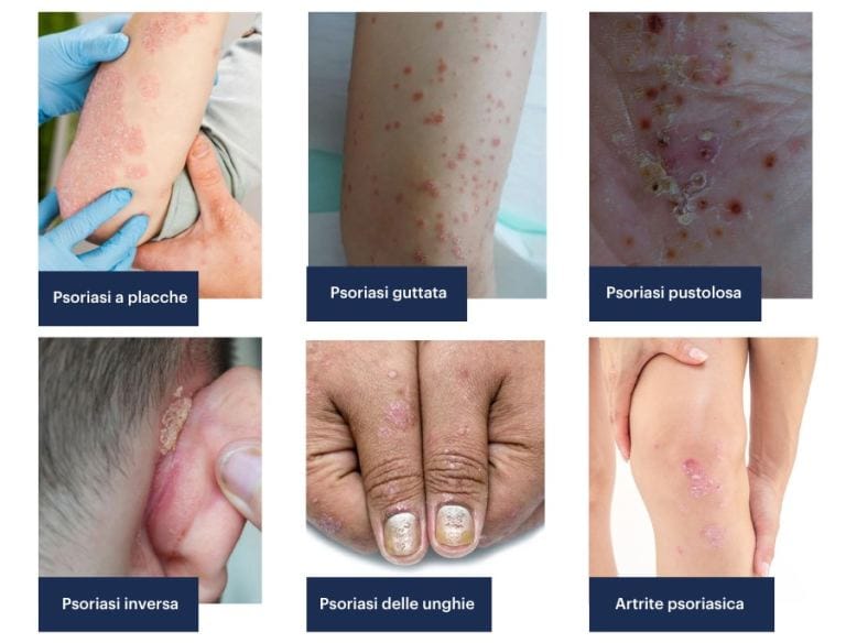 Alterazioni morfologiche della psoriasi