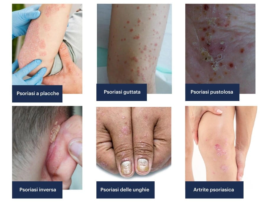 Alterazioni morfologiche della psoriasi
