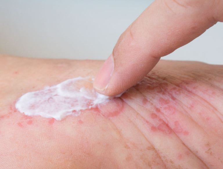 Come curare la dermatite atopica grave