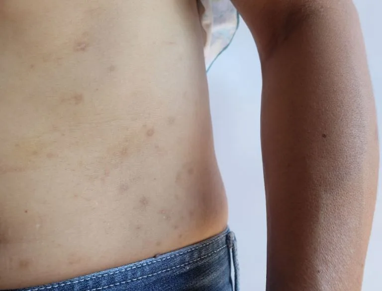 Dermatite atopica e acari