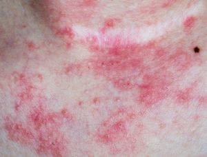 Dermatite atopica e asma