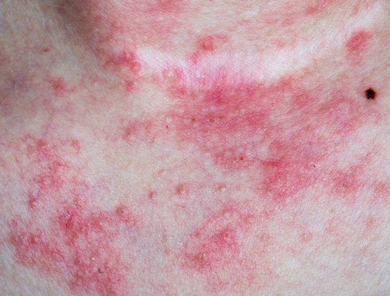Dermatite atopica e asma