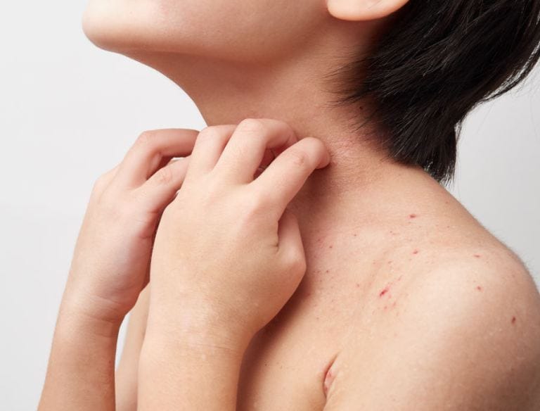 Dermatite atopica da sudore