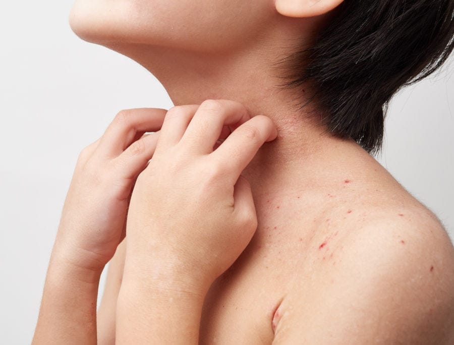Dermatite atopica da sudore