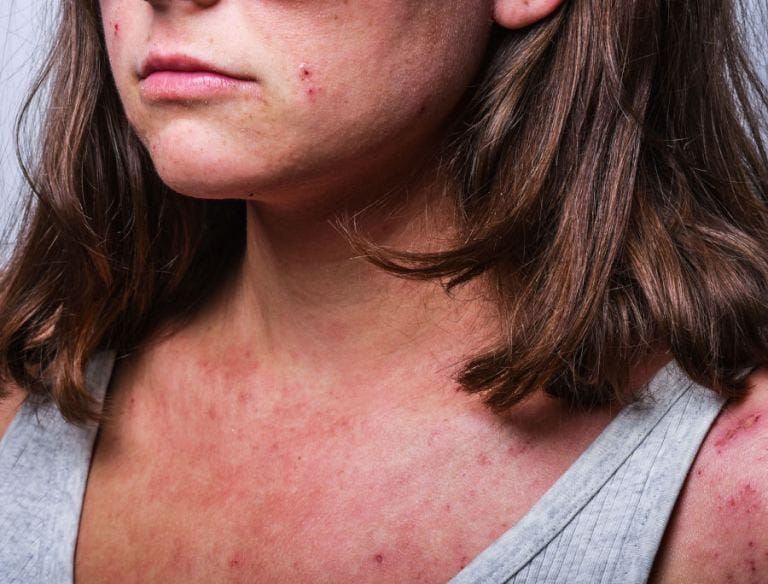 Come prevenire la dermatite atopica