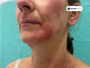 Cheilite e placche eritematodesquamative di dermatite atopica sul volto e collo con lesioni mieliceriche come da sovrainfezione batterica