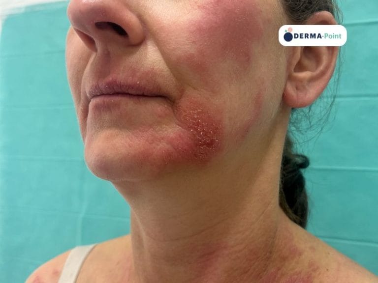 Cheilite e placche eritematodesquamative di dermatite atopica sul volto e collo con lesioni mieliceriche come da sovrainfezione batterica