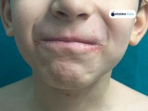 Dermatite atopica: cheilite caratterizzata da lichenificazione e spacchi ragadiformi