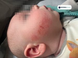 Dermatite atopica: chiazza eritematodesquamativa in guancia di lattante