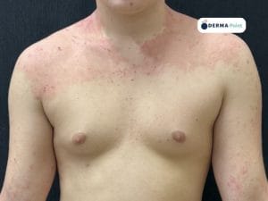 Dermatite atopica: chiazze eritematodesquamative in tronco, collo e cavi antecubitali di adolescente