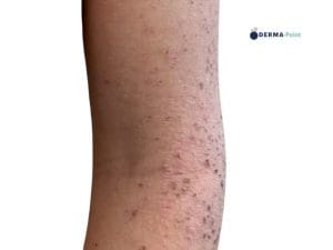 Dermatite atopica sul braccio