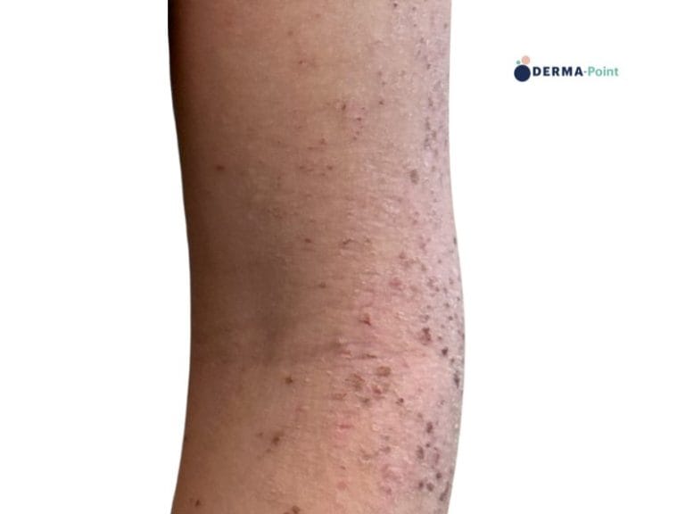 Dermatite atopica sul braccio