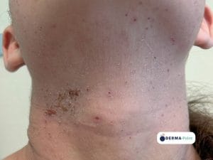 Dermatite atopica sul collo
