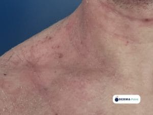 Dermatite atopica su collo e spalle