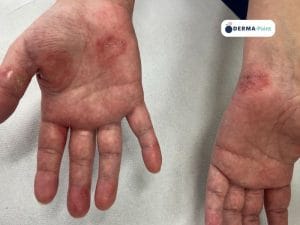 Dermatite atopica delle mani
