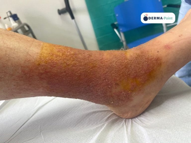 Dermatite da contatto a profumi in paziente con dermatite atopica