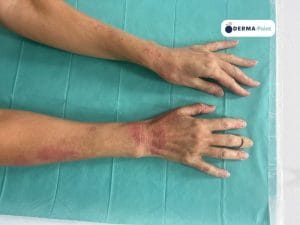 Lesioni eczematose di avambracci e dorso delle mani