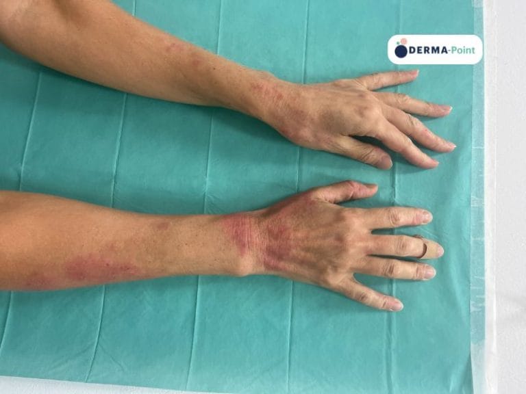 Lesioni eczematose di avambracci e dorso delle mani