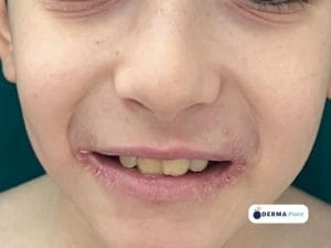 Pieghe di Dennie-Morgan e cheilite atopica