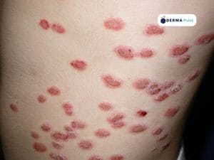 Psoriasi guttata: piccole chiazze