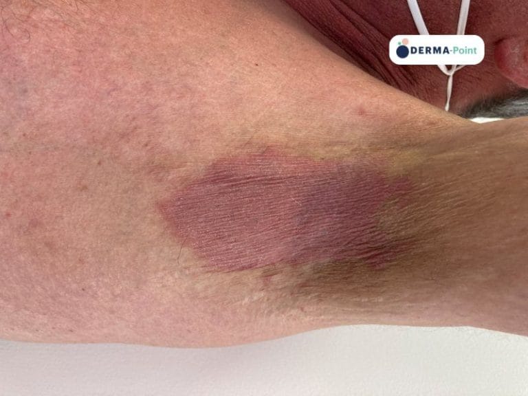 Psoriasi inversa nella zona ascellare