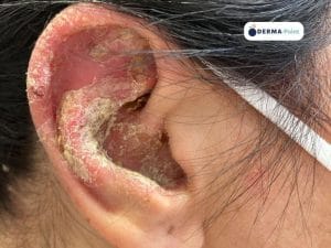 Psoriasi del padiglione auricolare