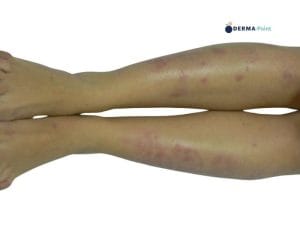 Psoriasi in placche degli arti inferiori in paziente donna