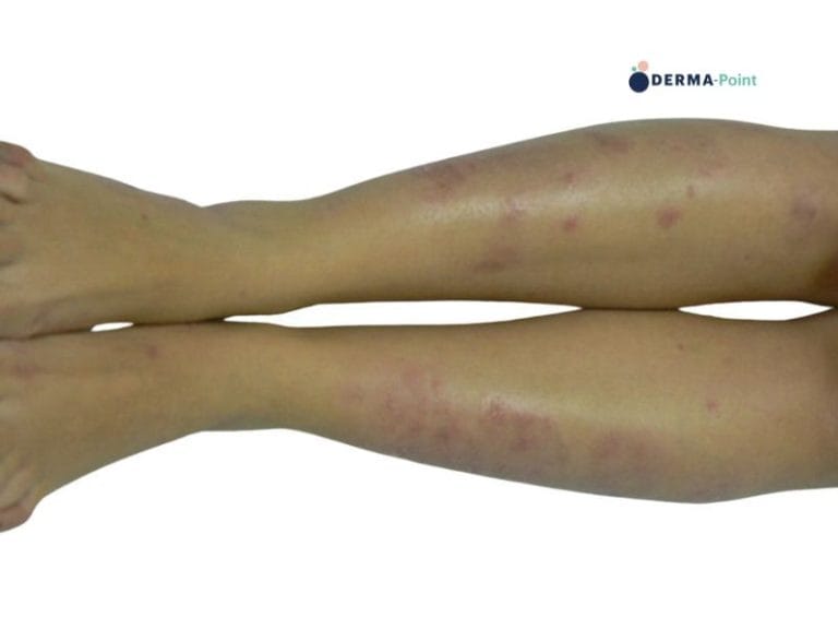 Psoriasi in placche degli arti inferiori in paziente donna