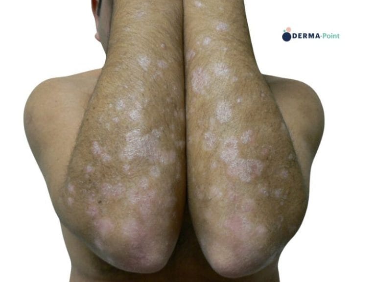 Psoriasi in placche degli arti superiori in paziente adulto