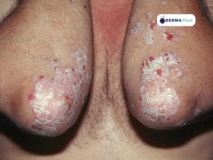 Psoriasi: placche eritemato-desquamative escoriate sui gomiti